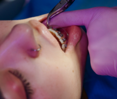Grandir sur la Rive-Sud : pourquoi un suivi orthodontique fait toute la différence